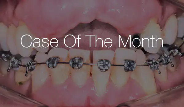 Image for case Reconstruction of the anterior maxilla using the allogenic shell technique