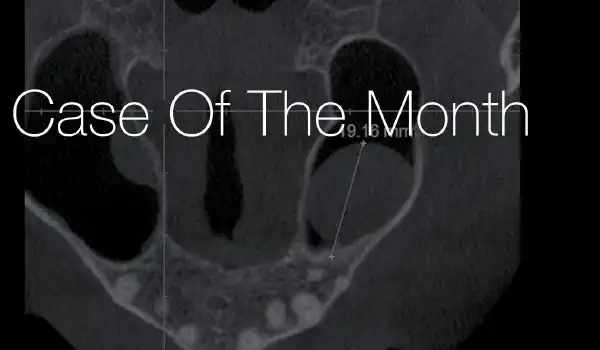 Image for case Maxillary sinus cyst removal using the Crocodile Technique and subsequent lateral sinus lift with cerabone®, maxgraft® and Jason® membrane
