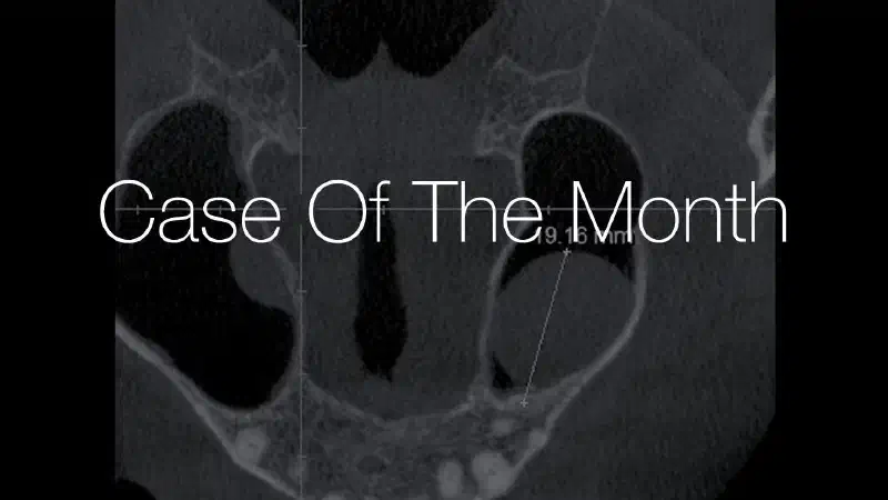 Maxillary sinus cyst removal using the Crocodile Technique and subsequent lateral sinus lift with cerabone®, maxgraft® and Jason® membrane