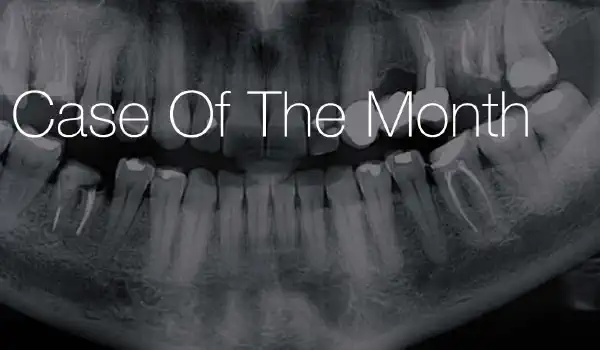 Image for case Synthetic approach for Socket Preservation