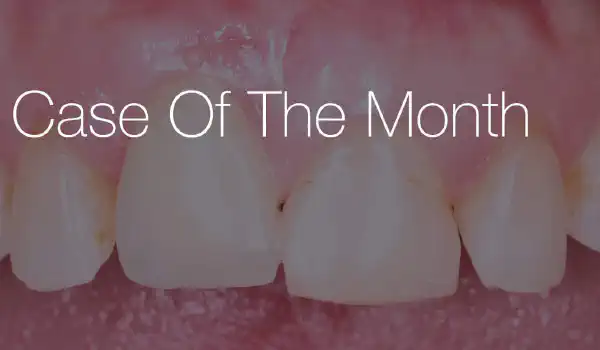 Image for case PERI-IMPLANTITIS TREATMENT IN THE AESTHETIC ZONE – HARD AND SOFT TISSUE RECONSTRUCTION