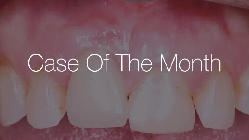 PERI-IMPLANTITIS TREATMENT IN THE AESTHETIC ZONE – HARD AND SOFT TISSUE RECONSTRUCTION