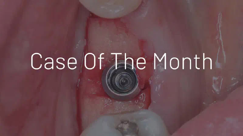 Peri-implant soft tissue augmentation with mucoderm® in the posterior mandible: A 5-Year Follow-Up