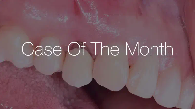 Alveolar ridge preservation: buccal bone wall dehiscence with NOVAMag® SHIELD
