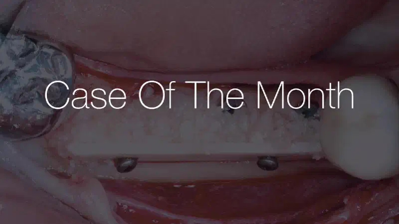 Simultaneous implantation and ridge augmentation using maxgraft® cortico, maxgraft® granules and mucoderm®