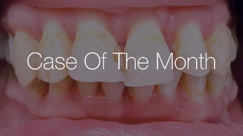 Regeneration in a Stage III Grade C periodontitis case using maxgraft® +HyA (XS) and Emdogain®