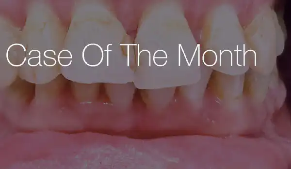 Image for case Regeneration in a Stage III Grade C periodontitis case using maxgraft® +HyA (XS) and Emdogain®