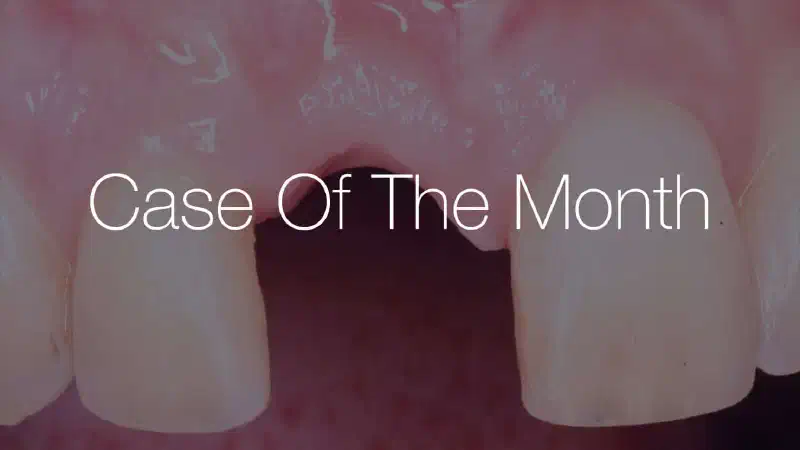 Delayed implant placement with GBR and soft tissue augmentation at the aesthetic area  –  2 years follow up