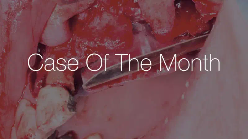 From Explantation to Functional Restoration: A Multi-Phase Maxillary Rehabilitation Case