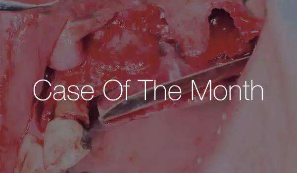 Image for case From Explantation to Functional Restoration: A Multi-Phase Maxillary Rehabilitation Case