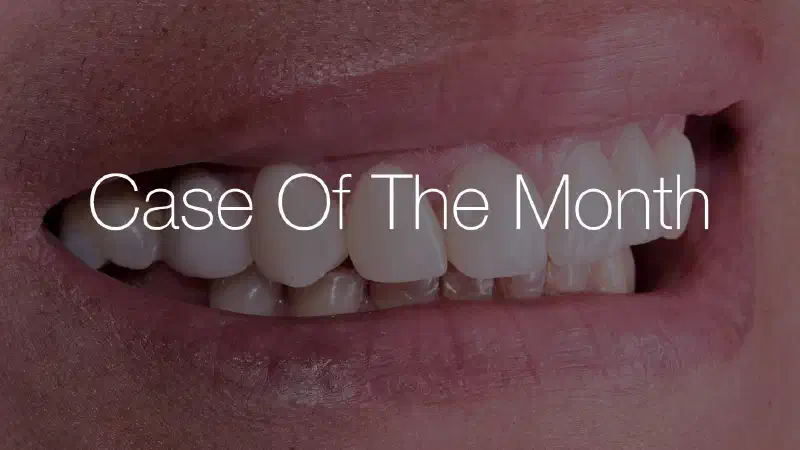 Management of a Late Ti Mesh Exposure in the Aesthetic Area using Jason® membrane & cerabone® in a Sausage Technique approach