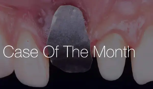 Image for case Delayed Implant Placement with NOVAMag® SHIELD and cerabone®