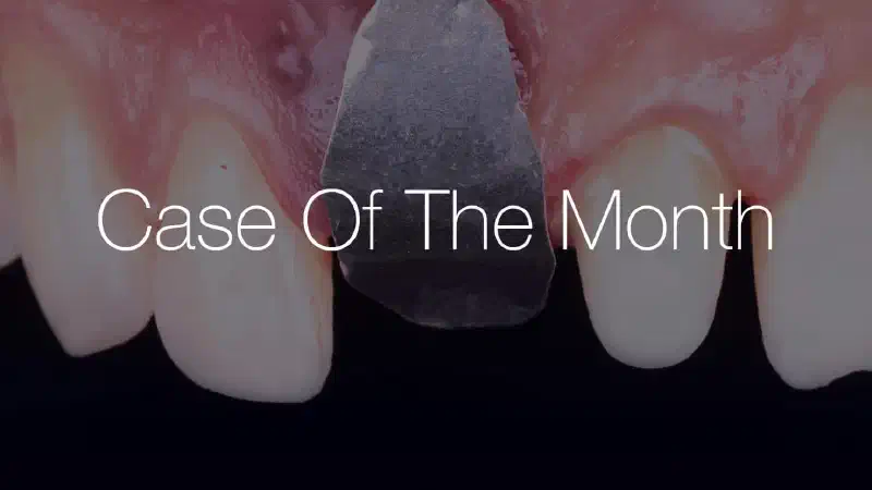 Delayed Implant Placement with NOVAMag® SHIELD and cerabone®