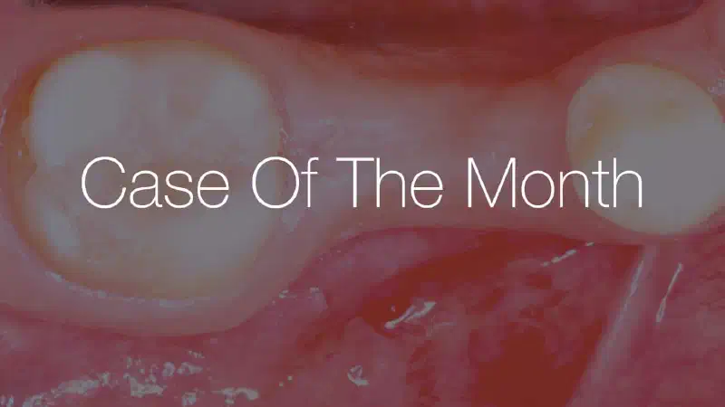 Delayed implant placement with NOVAMag® membrane in the mandible