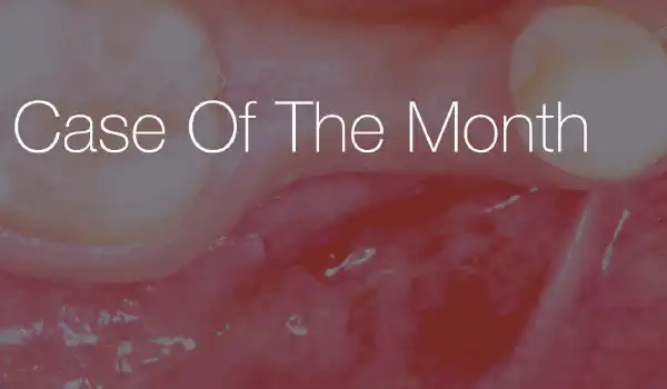 Image for case Delayed implant placement with NOVAMag® membrane in the mandible