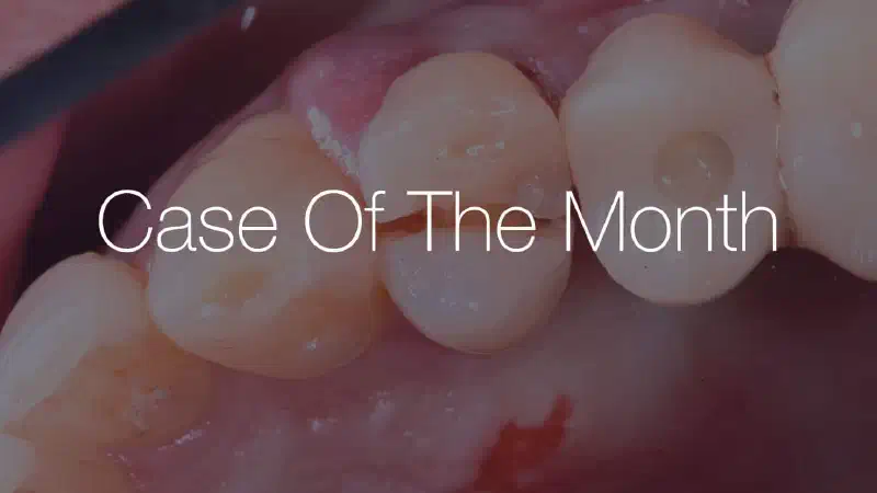 Immediate implantation after fracture of 2.4  –  soft tissue management using mucoderm®
