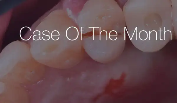 Image for case Immediate implantation after fracture of 2.4  –  soft tissue management using mucoderm®