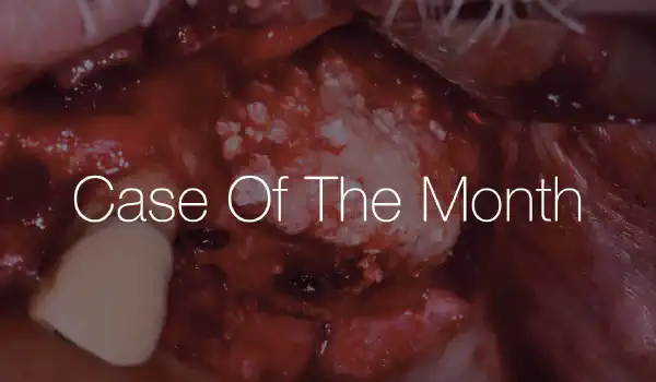 Image for case Sinus Augmentation and Lateral Ridge Reconstruction with Stable 3-Year Results