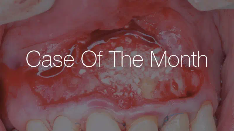 Aesthetic Buccal Flap and GBR for the Treatment of Extensive Apical Pathology