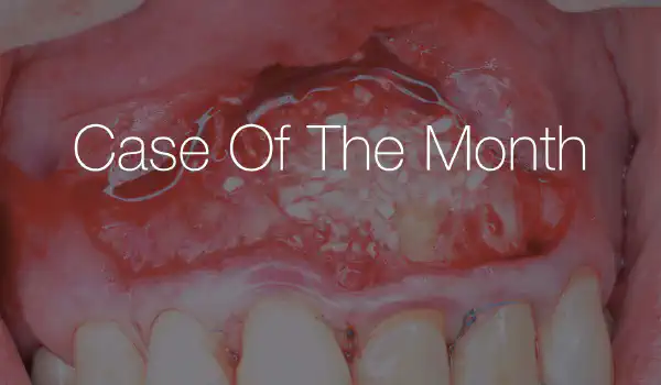 Image for case Aesthetic Buccal Flap and GBR for the Treatment of Extensive Apical Pathology