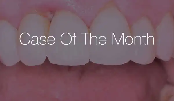 Image for case Maxillary bone reconstruction in the anterior area with cerabone® and Jason® membrane