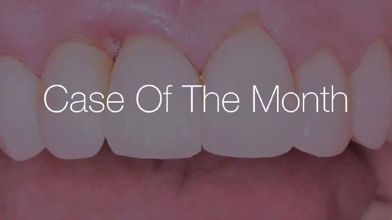 Maxillary bone reconstruction in the anterior area with cerabone® and Jason® membrane