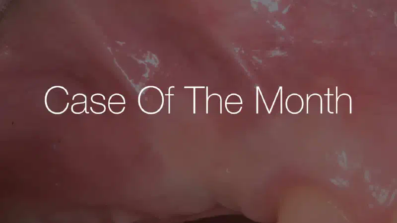 Soft tissue augmentation and ridge reconstruction using cerabone® +HyA and mucoderm®: A Seven-Month Clinical Outcome