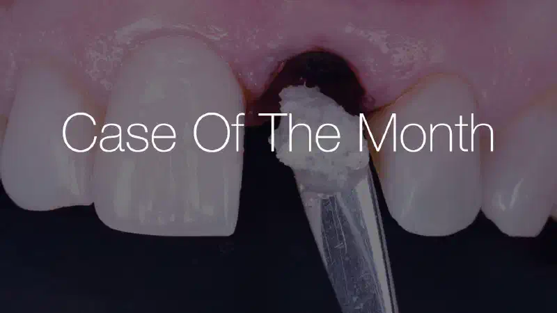 Excellent aesthetic result of buccal augmentation with mucoderm® and maxgraft® after immediate implant placement – 3-years follow-up