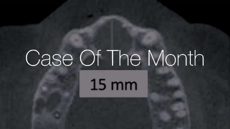 Use of a resorbable magnesium membrane for bone regeneration after large radicular cyst removal