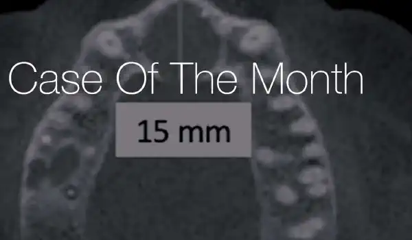 Image for case Use of a resorbable magnesium membrane for bone regeneration after large radicular cyst removal