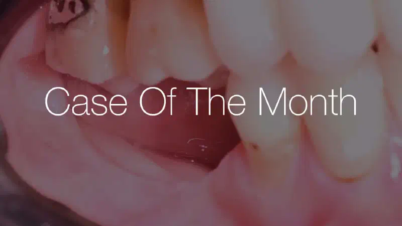 Posterior mandible reconstruction using permamem® and resorbable NOVAMag® fixation screws