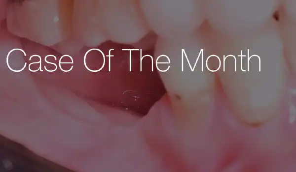 Image for case Posterior mandible reconstruction using permamem® and resorbable NOVAMag® fixation screws