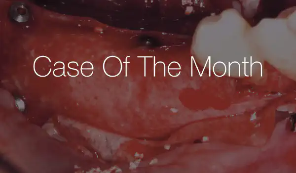 Image for case Horizontal ridge augmentation using Sausage Technique with cerabone® +HyA and Jason® membrane