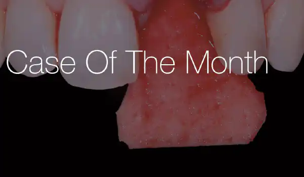 Image for case Long-term follow up at 11 years: wound closure and simultaneous soft tissue augmentation at fresh extraction sockets with mucoderm®