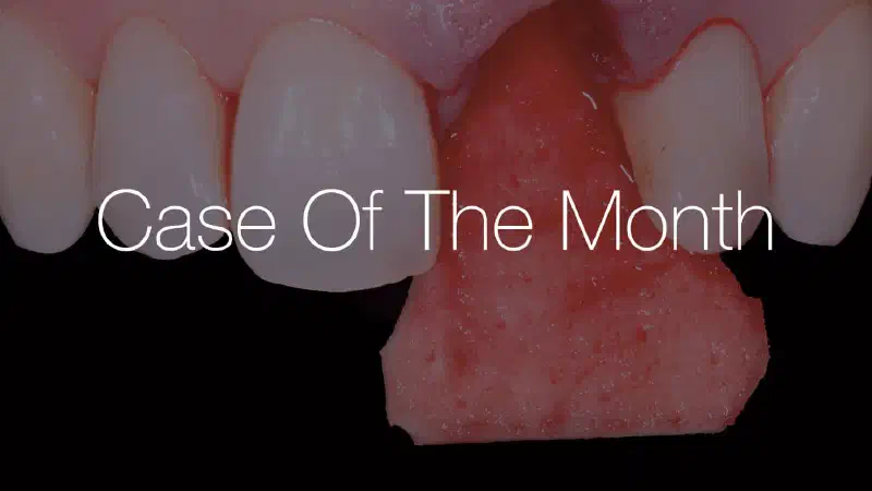 Long-term follow up at 11 years: wound closure and simultaneous soft tissue augmentation at fresh extraction sockets with mucoderm®