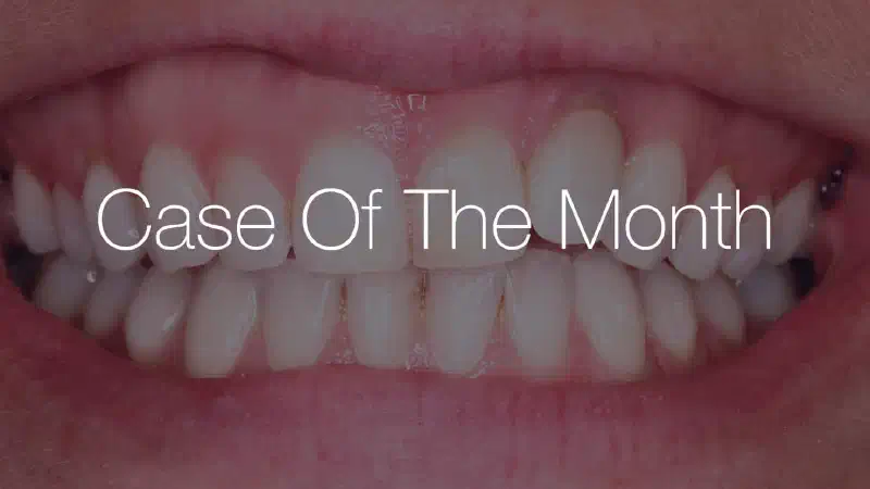 Replacement of a failing maxillary lateral incisor in a 36year old female patient