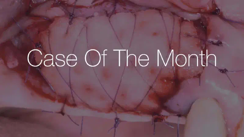 GBR with simultaneous implant placement and widening of KM with mucoderm®