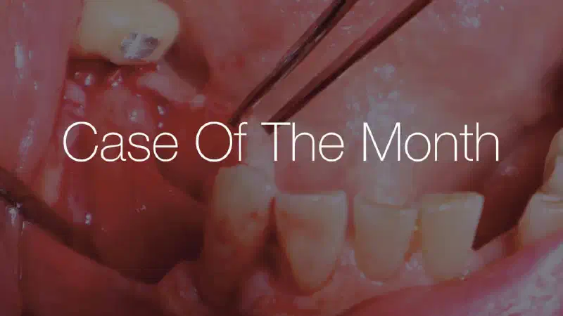 Horizontal ridge augmentation in the mandible using a customized allogenic bone block