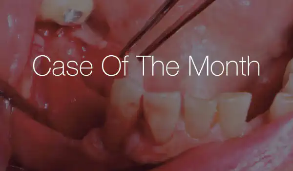 Image for case Horizontal ridge augmentation in the mandible using a customized allogenic bone block