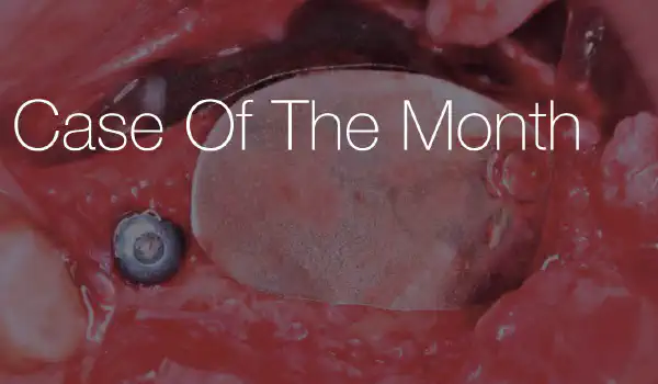 Image for case Large horizontal augmentation using the fully resorbable metal NOVAMag® membrane & cerabone®