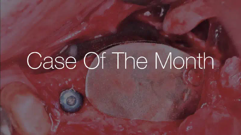 Large horizontal augmentation using the fully resorbable metal NOVAMag® membrane & cerabone®