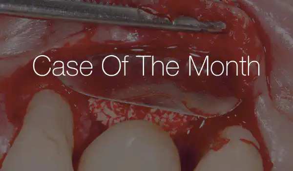 Image for case Treatment of peri-implantitis with Shield Technique using NOVAMag® SHIELD and cerabone® +HyA