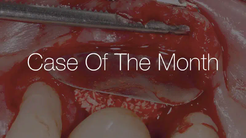Treatment of peri-implantitis with Shield Technique using NOVAMag® SHIELD and cerabone® +HyA