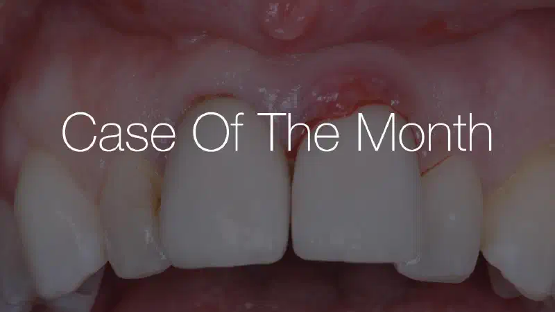GBR in the aesthetic zone with cerabone® and Jason® membrane