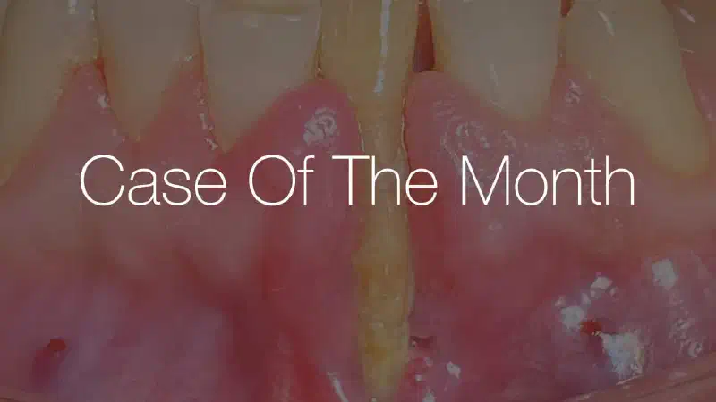 NOVAMag® plate technique with immediate implant after extraction of tooth with severe recession