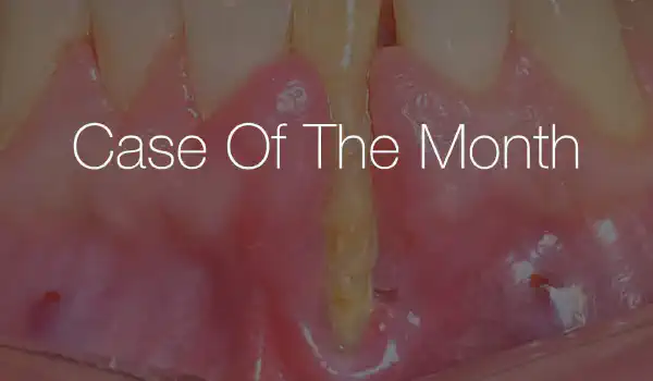 Image for case NOVAMag® plate technique with immediate implant after extraction of tooth with severe recession