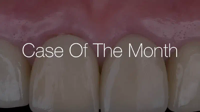 Peri-implant soft tissue thickening after ridge augmentation with cerabone® and Jason® membrane