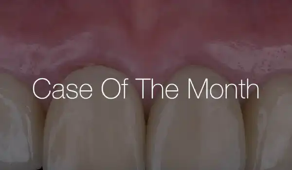 Image for case Peri-implant soft tissue thickening after ridge augmentation with cerabone® and Jason® membrane