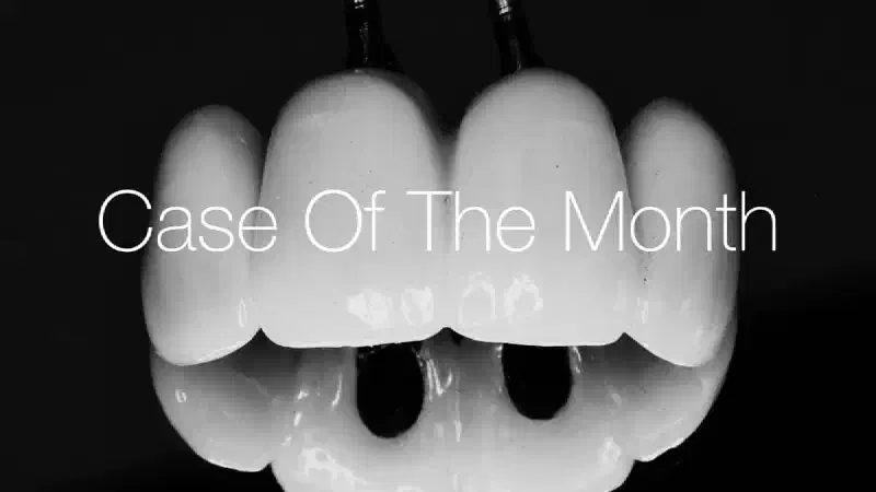 Replacement of four failing maxillary incisors due to chronic infection and external root resorption