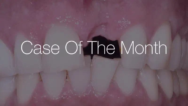 Block augmentation in the aesthetic zone with maxgraft® and cerabone®